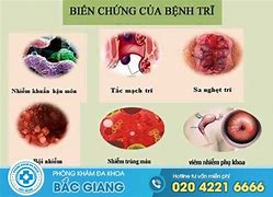 Khám Bệnh Trĩ Ở Nhật